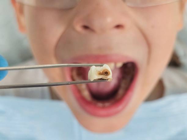 Best Emergency Dentist for Lost Fillings or Crowns in Crystal Falls, MI