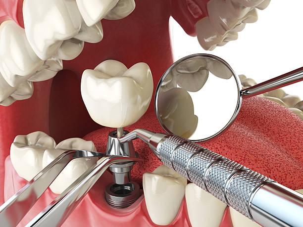 Best Emergency Root Canal Treatment in Crystal Falls, MI